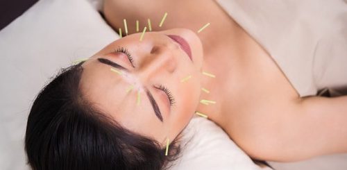 What is Acupuncture?