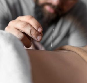 What is Acupuncture?