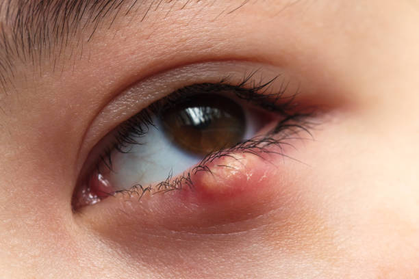 What Is the Spiritual Meaning of a Stye? Inner Conflict!